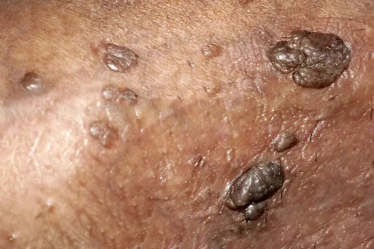 Como Saber se Tenho HPV? Sintomas, Tipos e Testes do Vírus