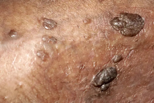 Como Saber se Tenho HPV? Sintomas, Tipos e Testes do Vírus
