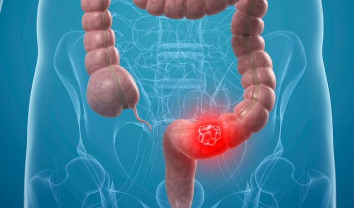 Rastreio de câncer Intestino